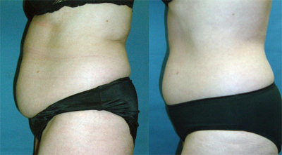 Zerona Results